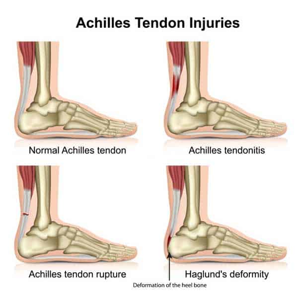 common achilles heel injuries from wearing flip flops