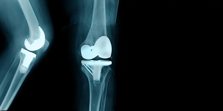 knee replacement surgery rediscovery