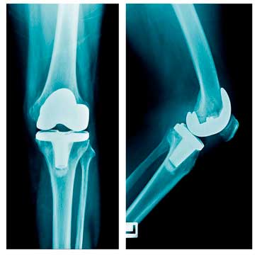 knee-replacement-surgery